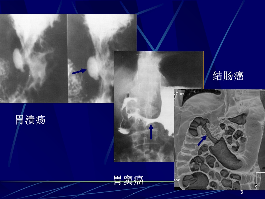 胃肠道正常影像表现基本病变课件.ppt_第3页