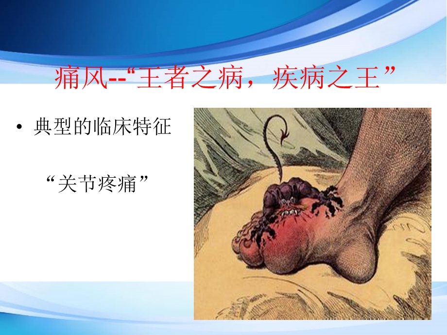 痛风讲课课件.ppt_第3页