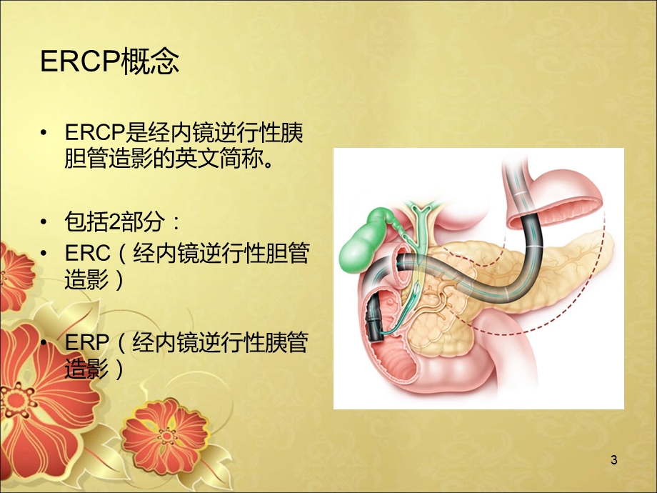 胆总管结石ERCP术围手术期护理课件.ppt_第3页