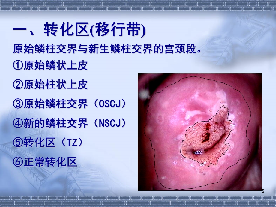 宫颈病变几个重要概念及问题课件ppt.ppt_第3页