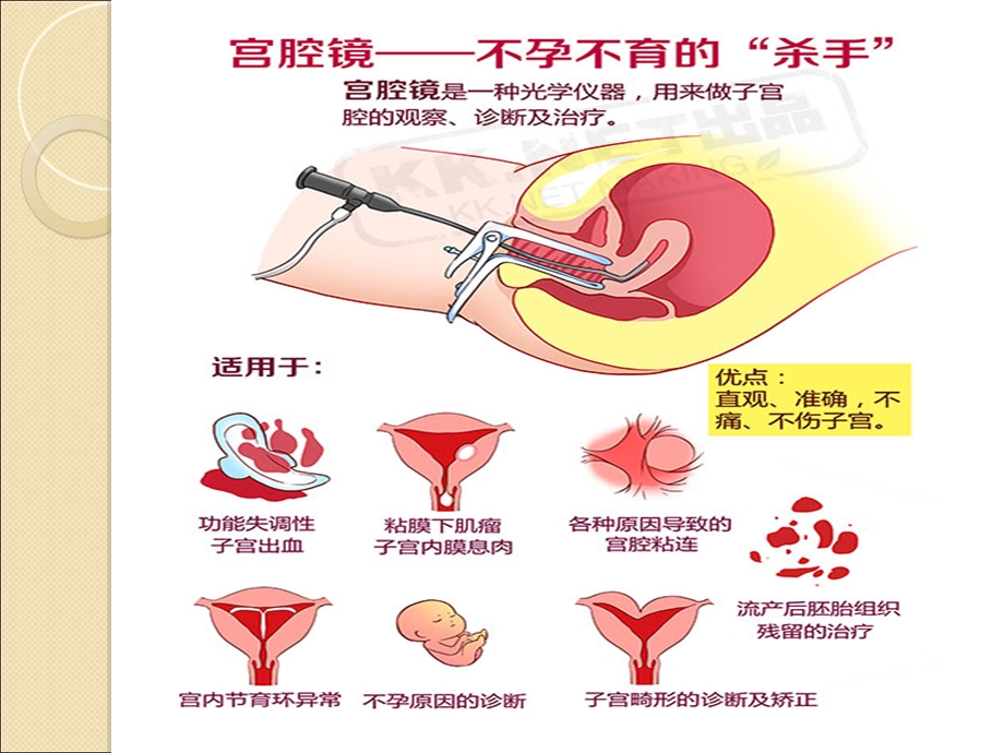 宫腔镜在妇科临床的应用基础知识课件.ppt_第3页