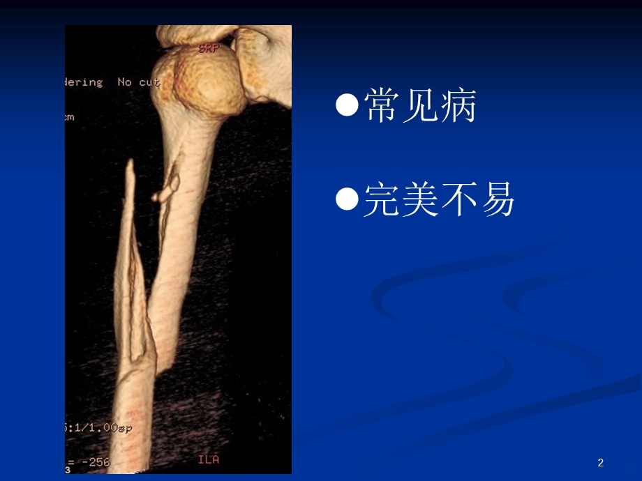 肱骨干骨折精品课件.ppt_第2页