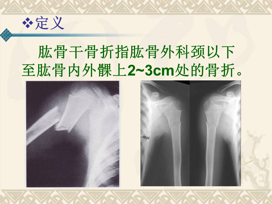 肱骨干骨折课件.ppt_第2页