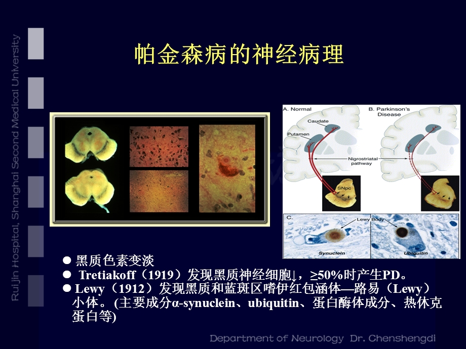 帕金森病诊断与治疗策略课件.ppt_第2页