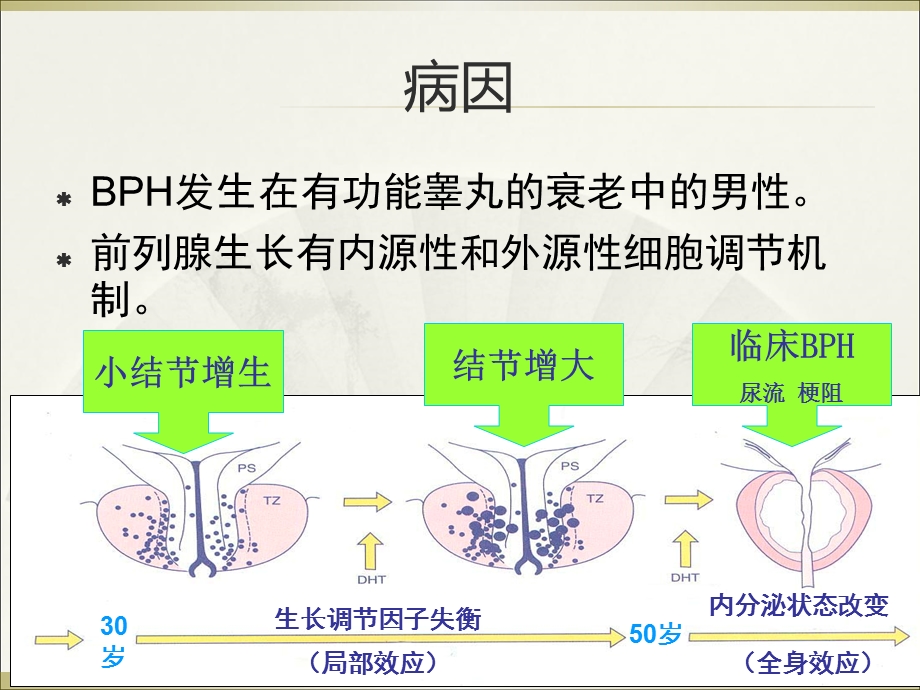 良性前列腺增生的治疗课件.ppt_第3页