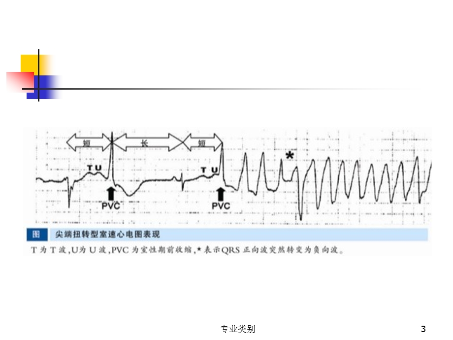 尖端扭转型室速(行业精制)课件.ppt_第3页