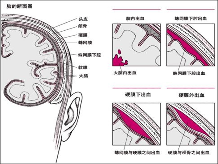 神经外科常见引流管的护理课件.ppt_第2页