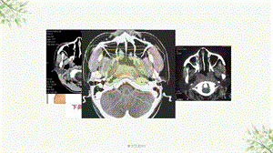 鼻咽癌放射治疗中常见并发症及处理ppt课件.ppt