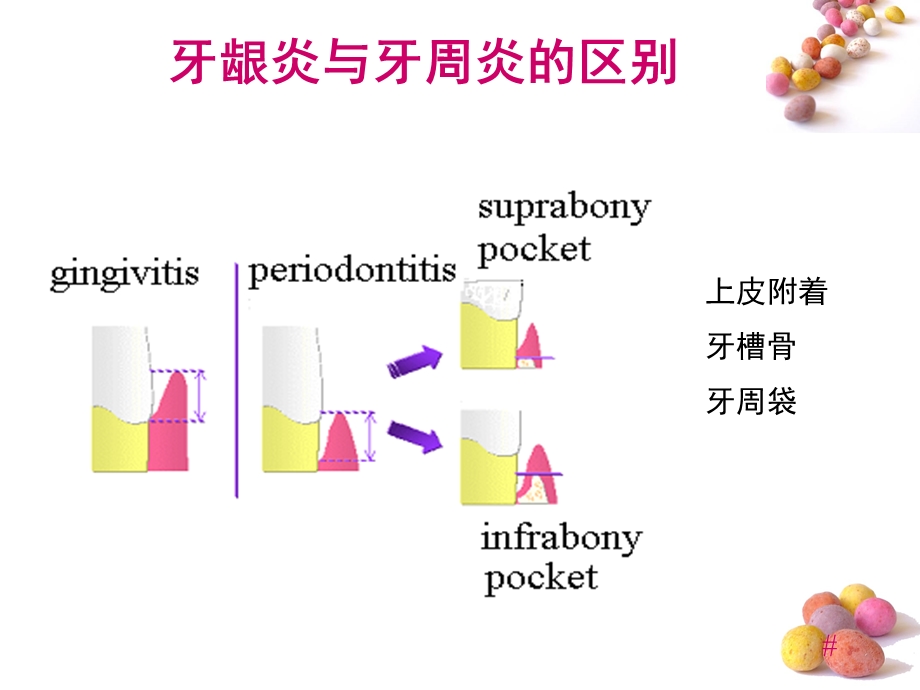 龈下刮治术课件.ppt_第3页