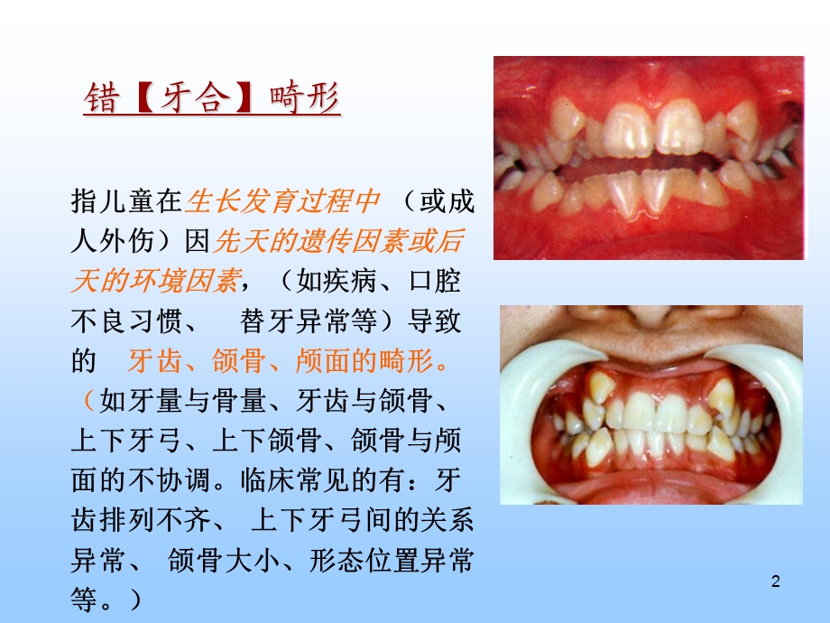 错颌畸形的病因课件PPT.ppt_第2页