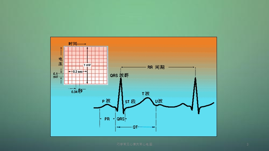 2020年巧学常见心律失常心电图（课件）.ppt_第3页