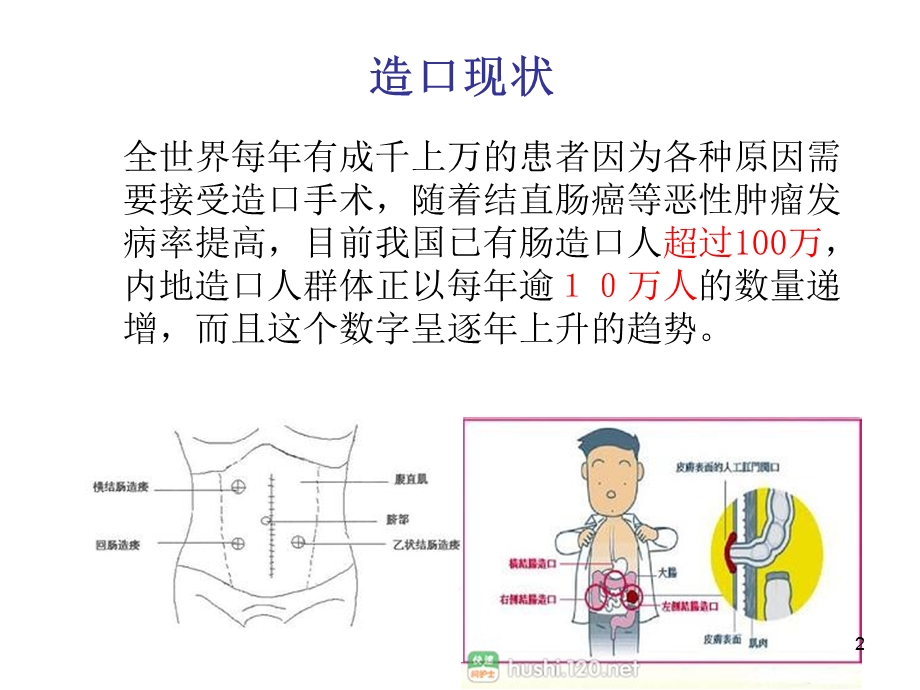 造口护理健康宣教课件.ppt_第2页