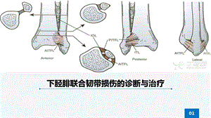 下胫腓联合韧带损伤ppt课件.ppt