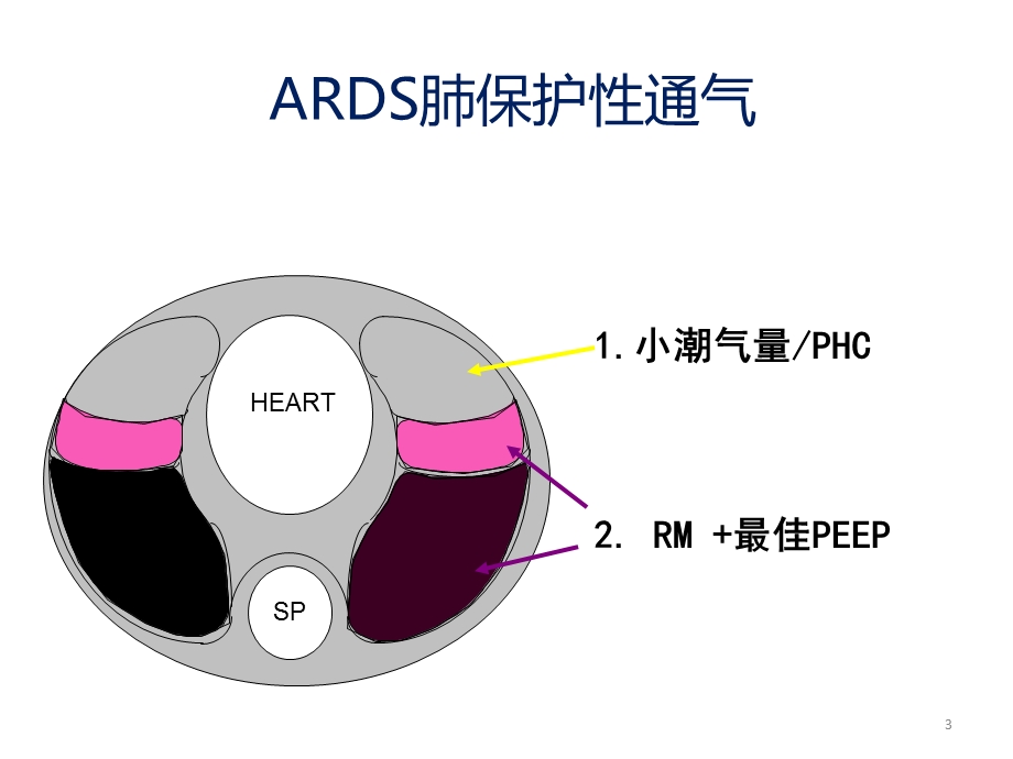 ARDS肺可复张性评估课件.ppt_第3页