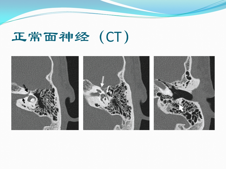 面神经解剖及病变课件.pptx_第3页