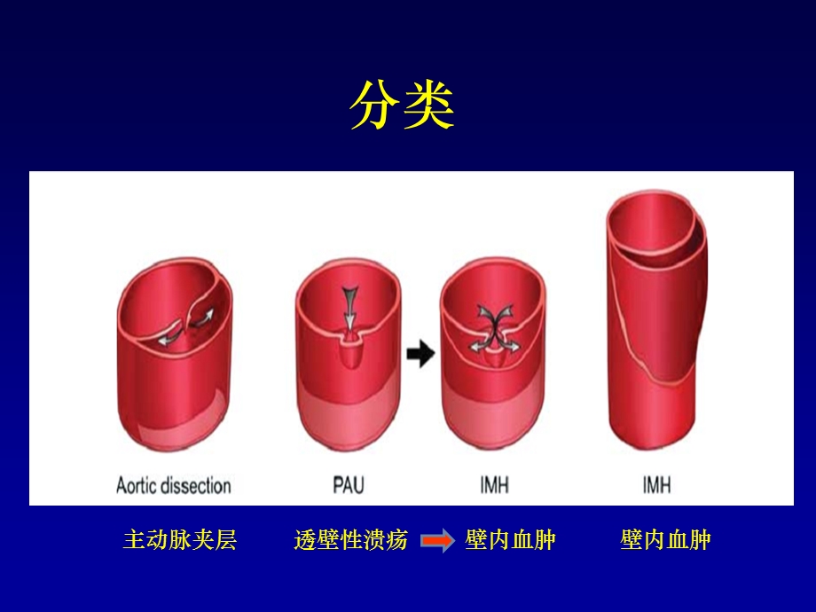 急性主动脉综合征处理过程中应注意的几个问题课件.ppt_第3页