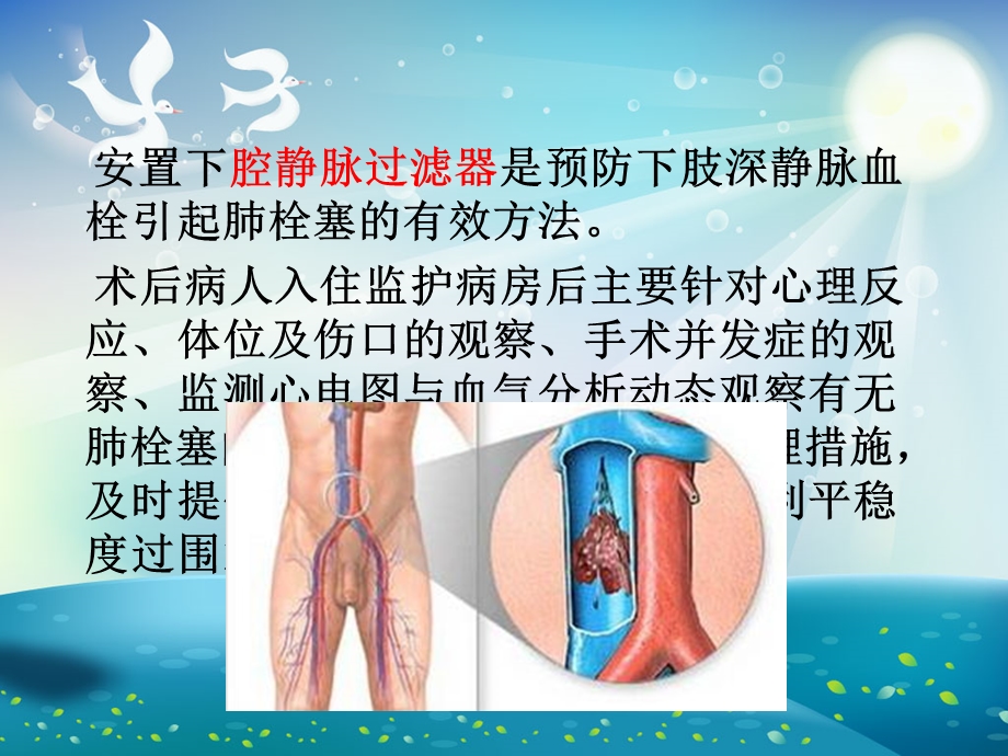 下腔静脉滤器植入术后护理ppt课件.ppt_第2页