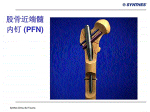 PFN股骨近端髓内钉课件.ppt