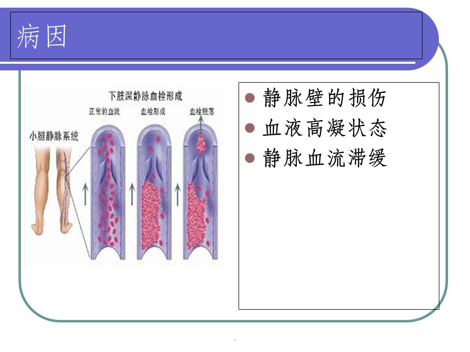 下肢静脉血栓个案护理课件.ppt_第3页