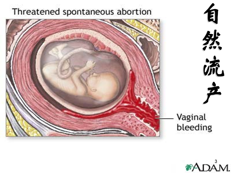 不全流产课件.ppt_第3页