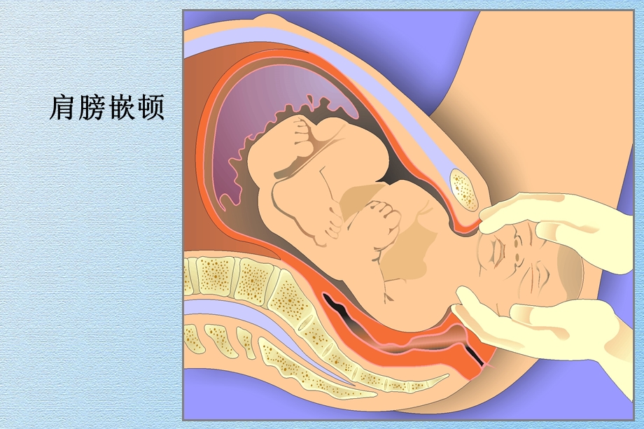 分娩过程中肩难产课件.ppt_第3页