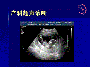 产科超声诊断(讲义)课件.ppt