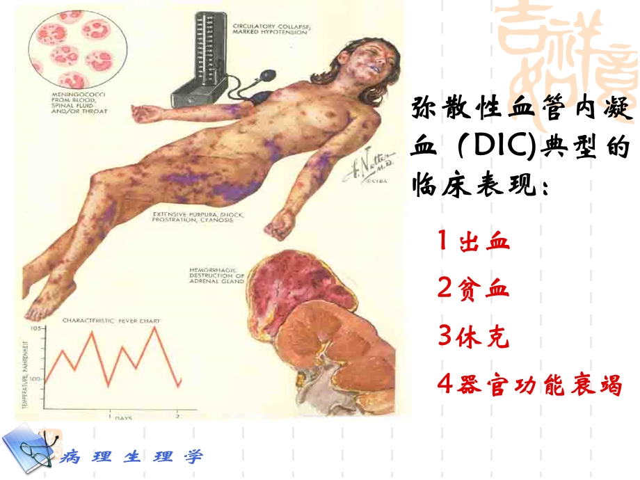 凝血和抗凝血平衡紊乱课件.ppt_第3页