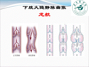 下肢大隐静脉曲张课件.ppt