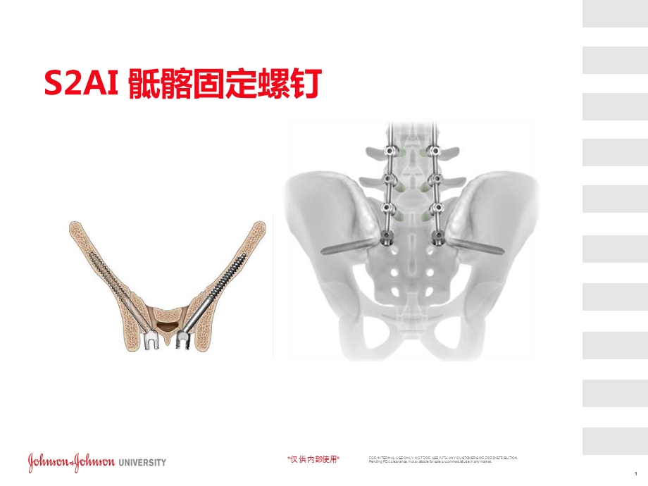 S2AI螺钉植入技巧课件.ppt_第1页