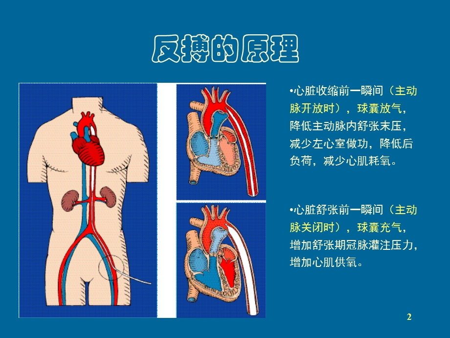 主动脉内球囊反搏泵 课件.ppt_第2页