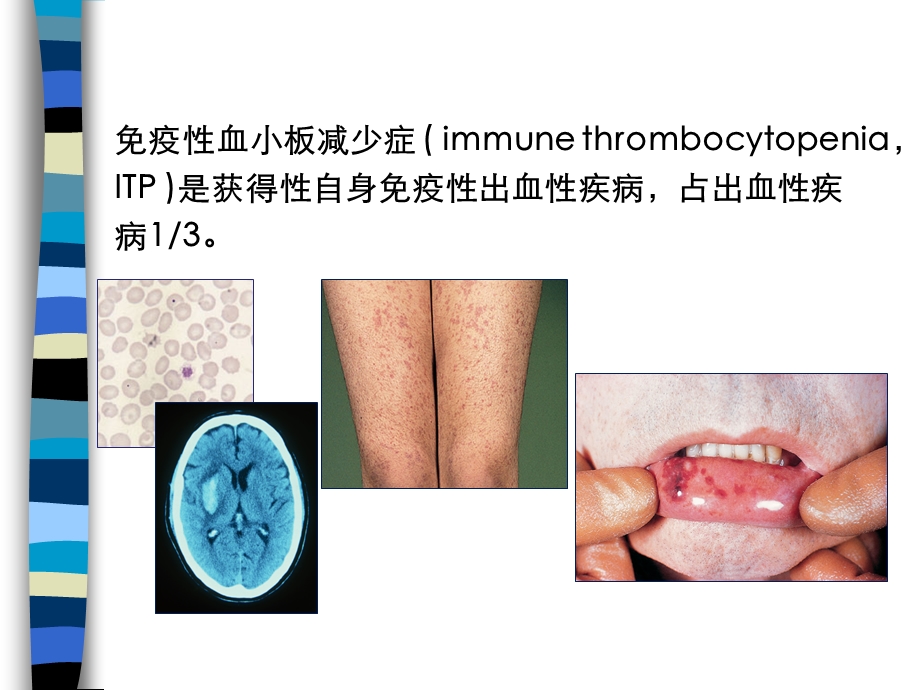 免疫性血小板减少症诊断与治疗课件.pptx_第2页