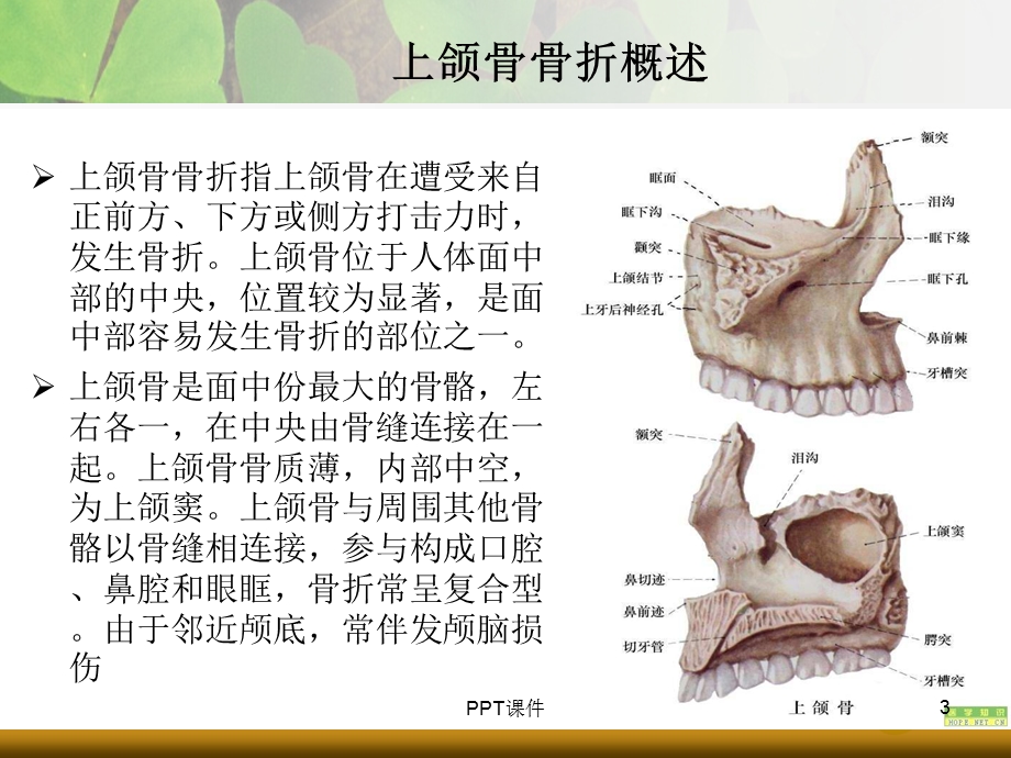 上下颌骨骨折课件.ppt_第3页