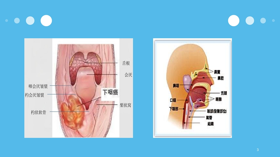 下咽癌术后患者护理查房课件.ppt_第3页