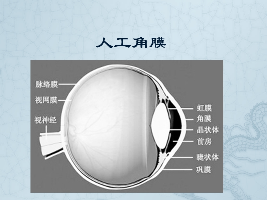 人工眼角膜资料课件.ppt_第1页