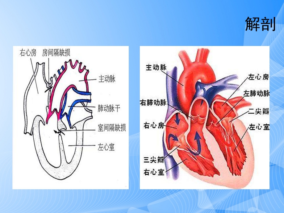 房间隔缺损护理查房PPT文档课件.ppt_第3页