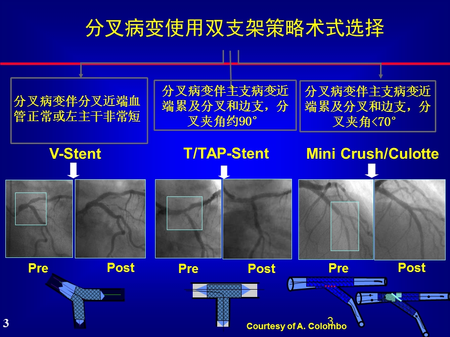 复杂分叉病变Culotte支架技术解读课件.ppt_第3页