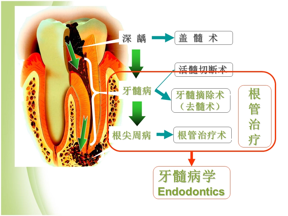 根管治疗课件.ppt_第2页