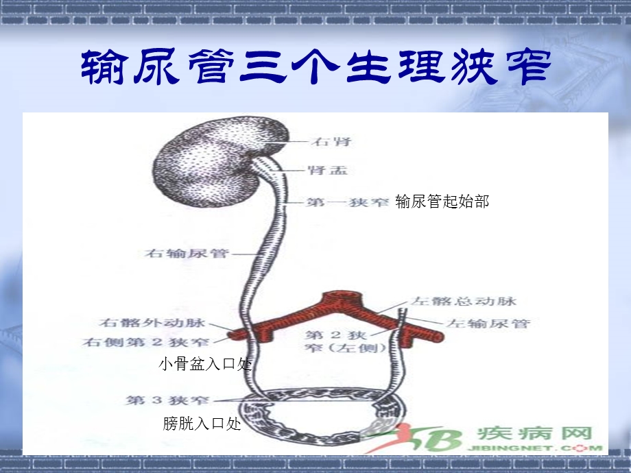 输尿管结石病人的护理课件.ppt_第3页