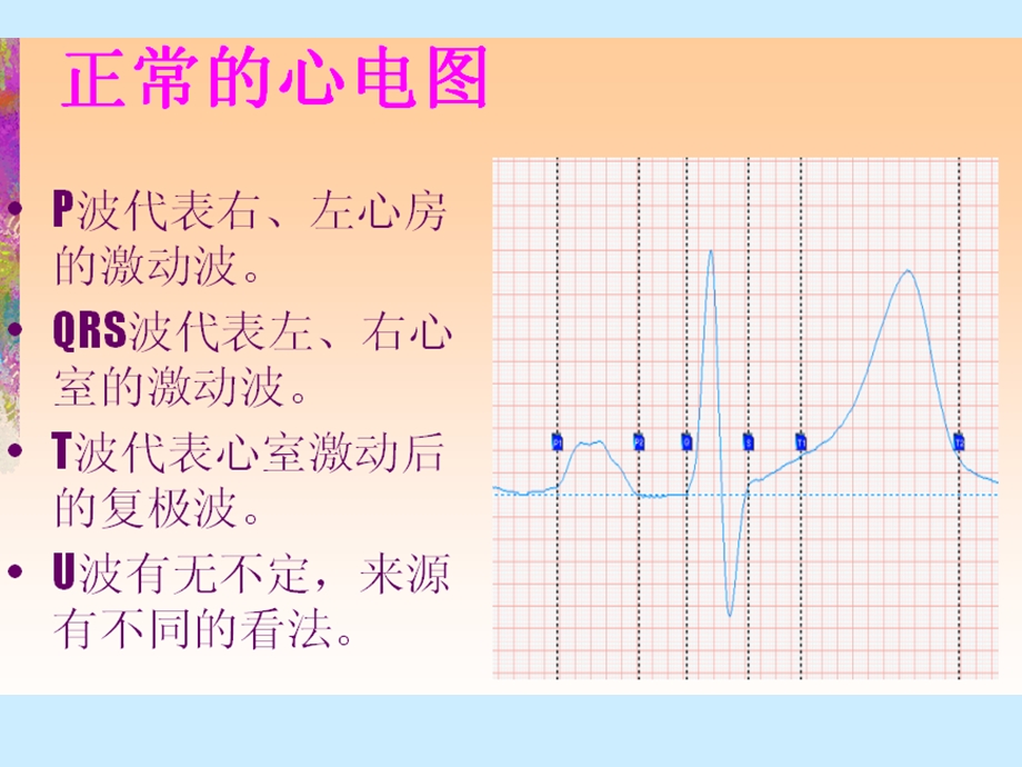 解读常见心电图课件.ppt_第2页