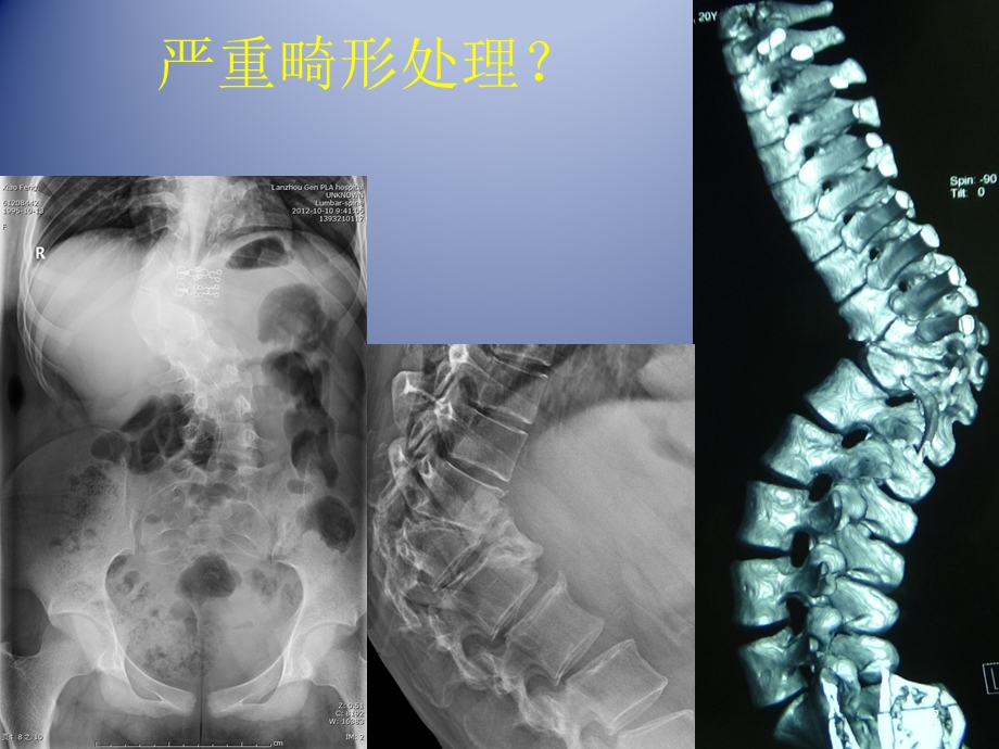 椎体截骨治疗脊柱畸形课件.ppt_第2页