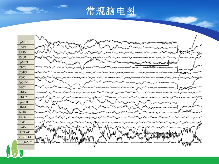 振幅整合脑电图在临床的应用课件.ppt_第2页