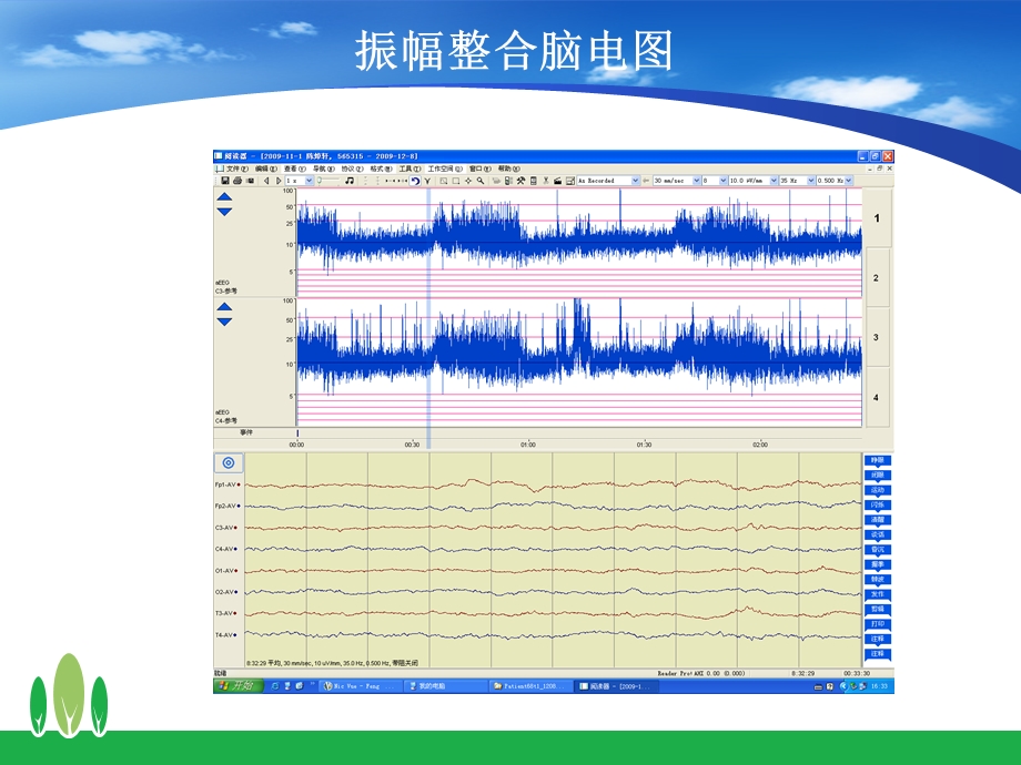 振幅整合脑电图在临床的应用课件.ppt_第3页