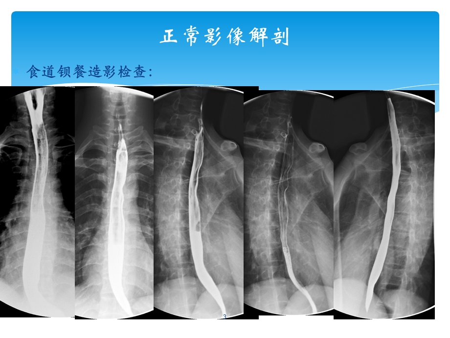 食道癌的影像学解读 课件.ppt_第3页