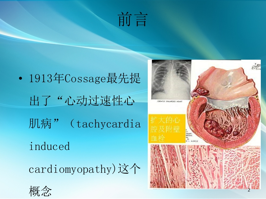 心动过速心肌病课件.ppt_第2页