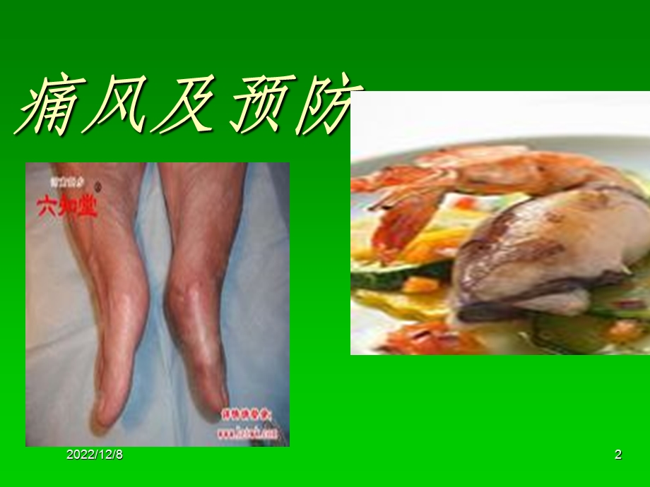 痛风病课件.ppt_第2页