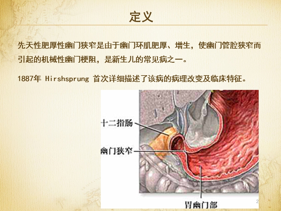 肥厚性幽门狭窄课件.ppt_第2页