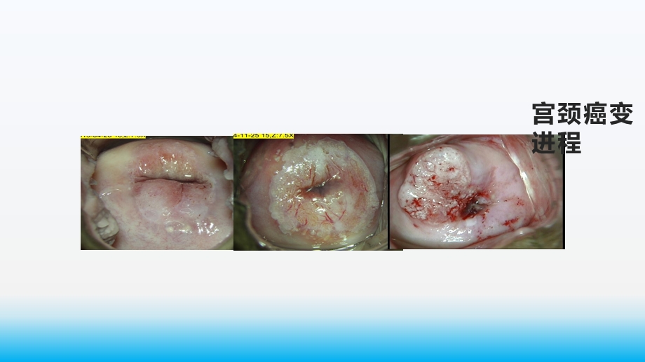 宫颈癌筛查及筛查后异常结果的管理课件.pptx_第3页