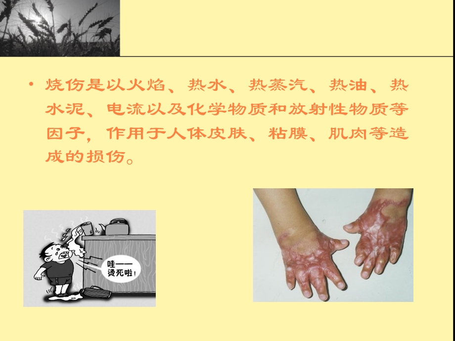 烧伤的作业治疗课件.ppt_第2页