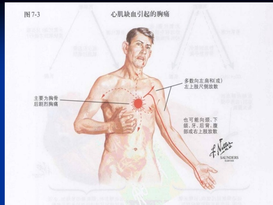 冠心病超声诊断最新总结课件.ppt_第3页