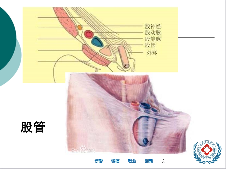 股疝与腹股沟疝的CT鉴别课件.ppt_第3页